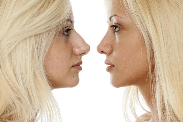 Before and after rhinoplasty profile comparison at Park Facial Plastics in Beverly Hills.